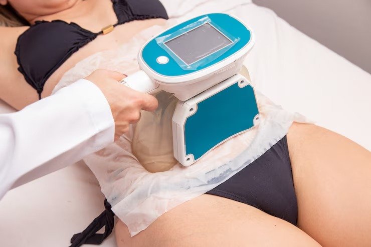 imgi 9 cerrar foto procedimiento tratamiento grasas criolipolisis salon 432566 4720